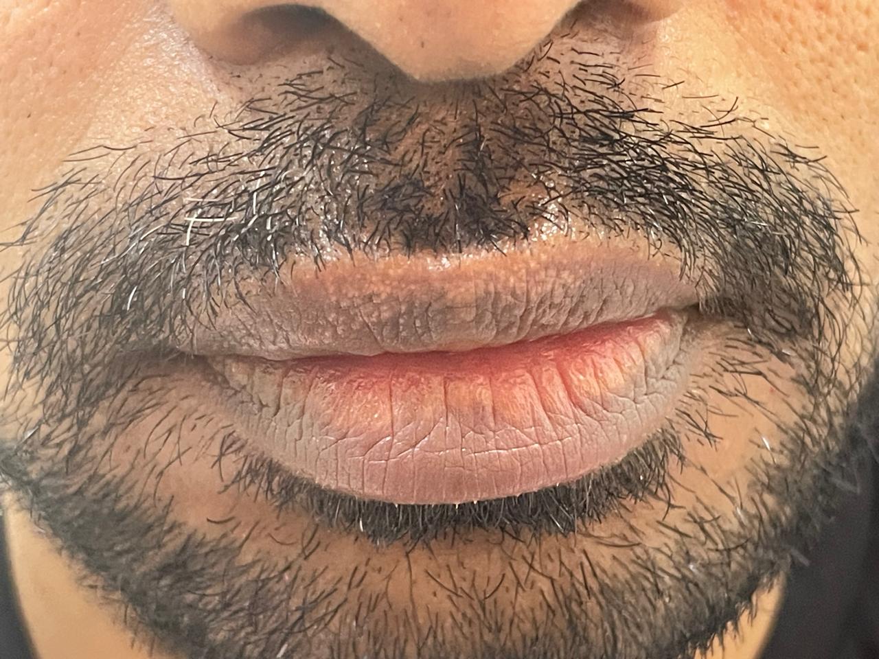 After - Pigmentation